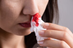 Girl Bloody Nose Tissue