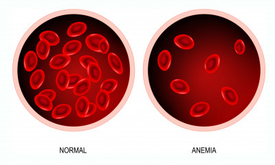 WHAT IS ANEMIA? SYMPTOMS AND TREATMENT OPTIONS.